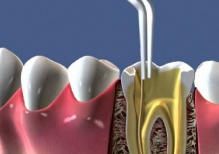 Когда пломбирование зуба признается качественным?