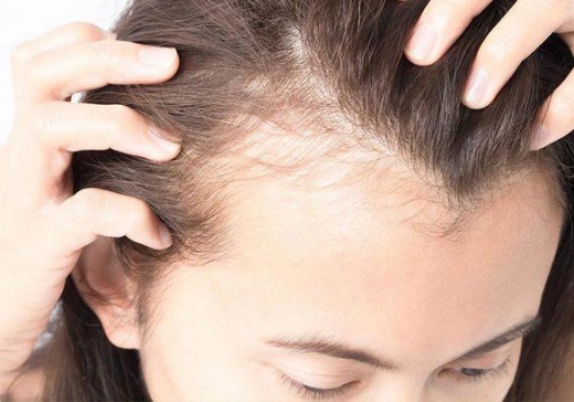 Эксперт KDL назвал 5 причин выпадения волос